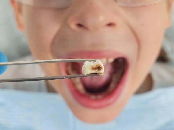Best Cracked Tooth Emergency Dentist  in Morris, AL